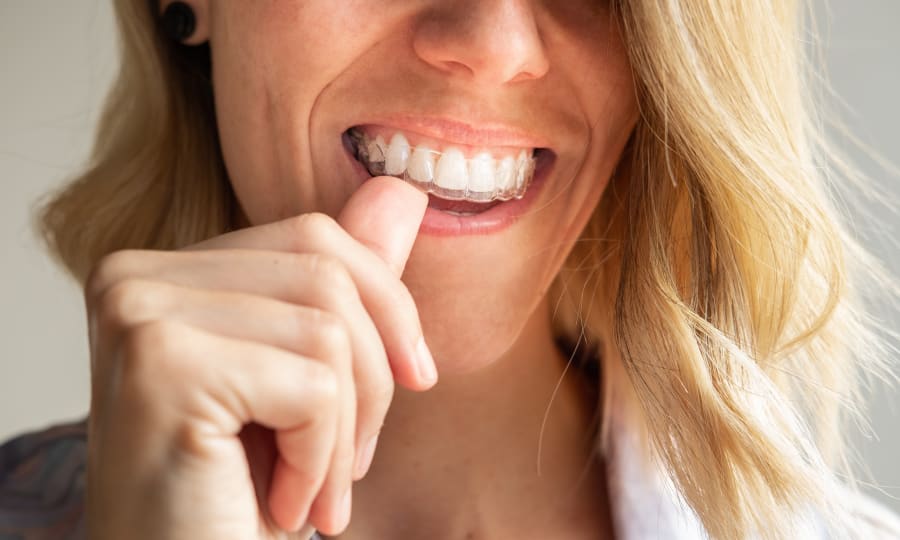 Low-Profile Aesthetics of Clear Aligners at Munk Orthodontics
