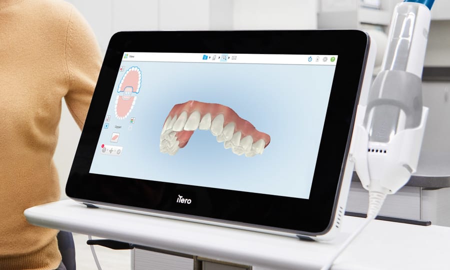 Digital Impressions with iTero for Clear Aligners at Munk Orthodontics
